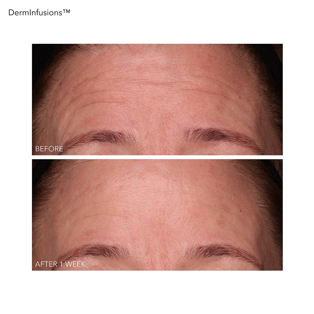 DDG_DermInfusions_B&A_panna