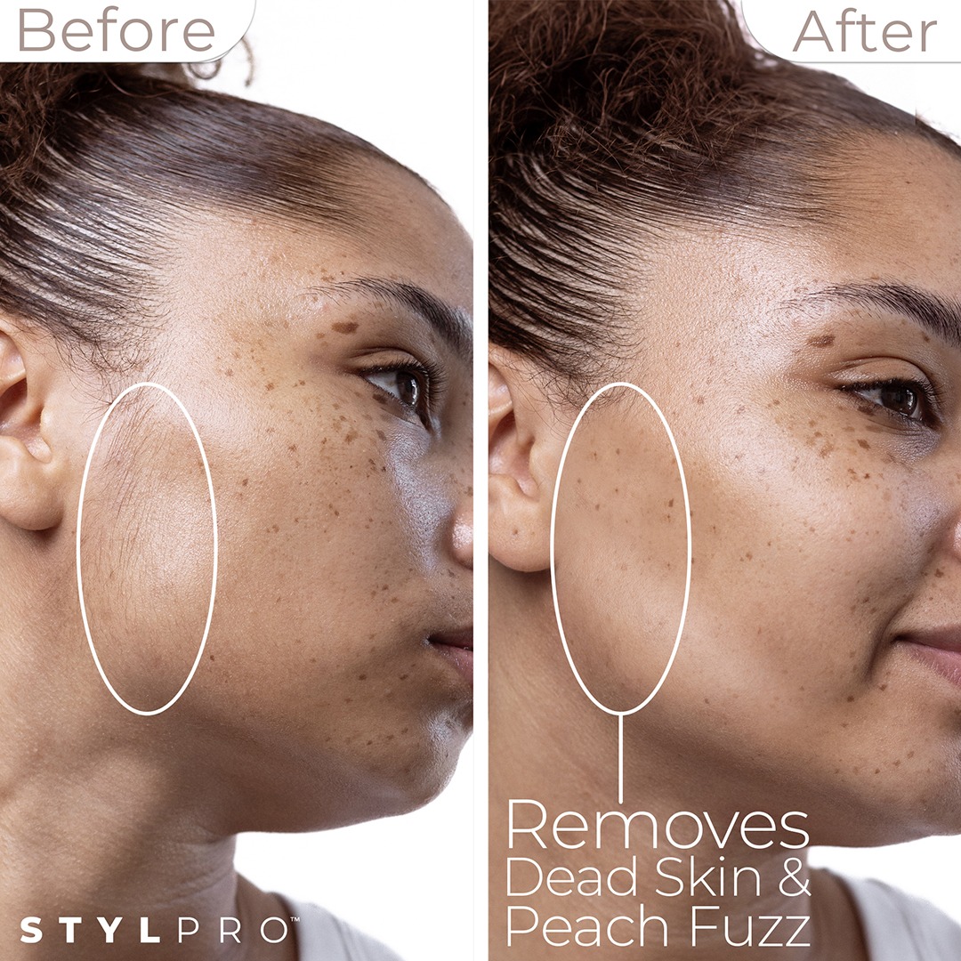 5 - Sonic Dermaplane B&A