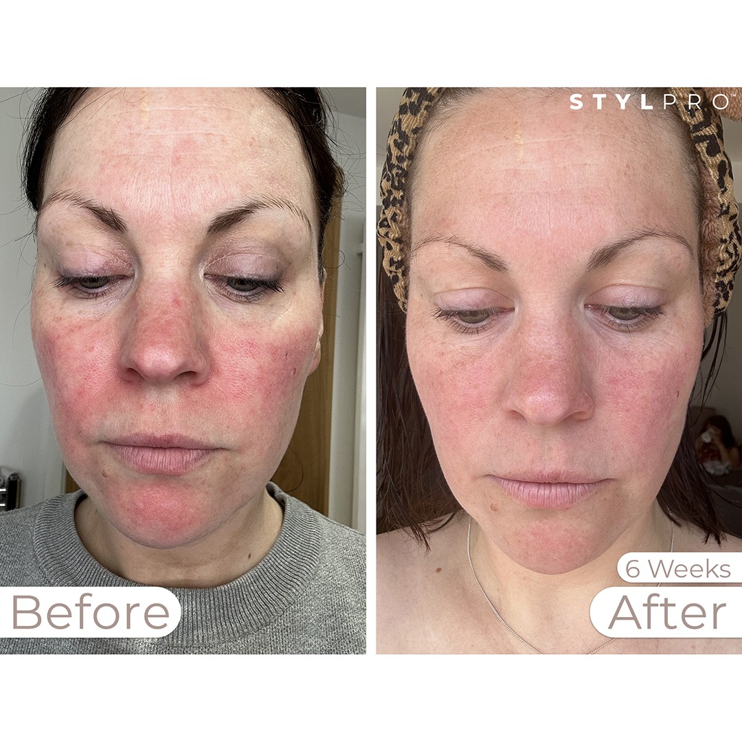 STYLPRO MASK Before & After 1
