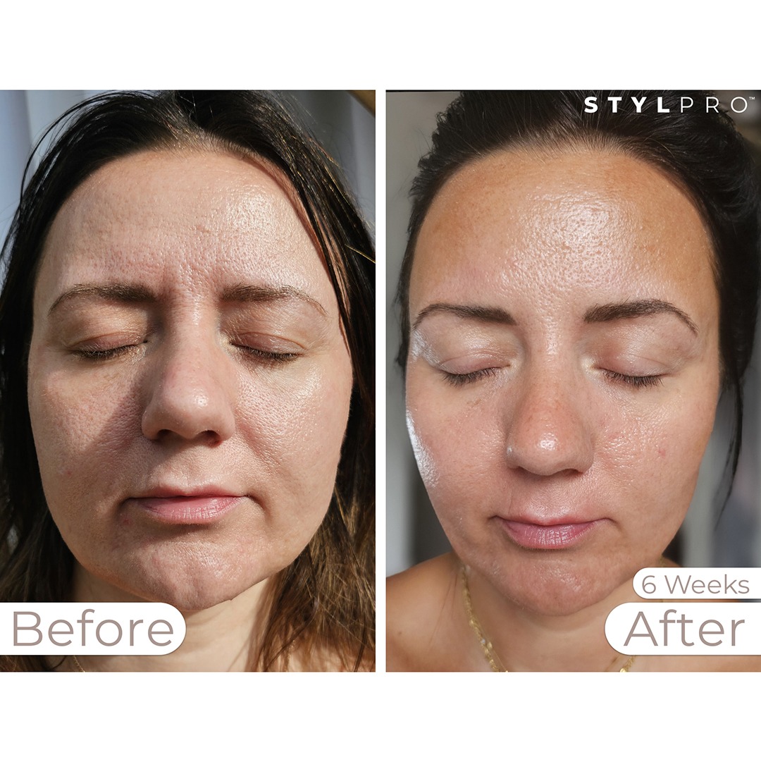 STYLPRO MASK Before & After 2