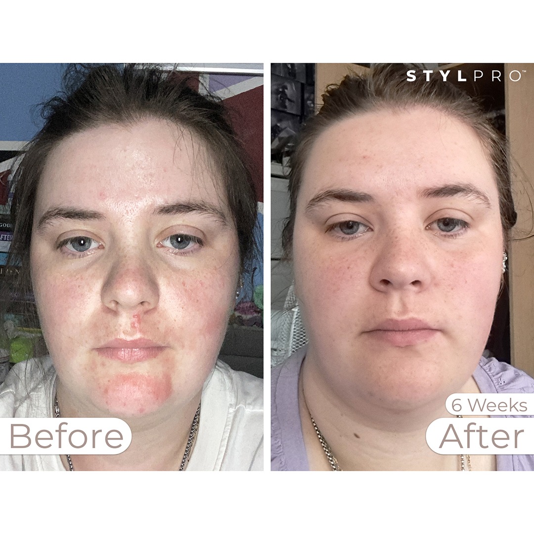 STYLPRO MASK Before & After 3