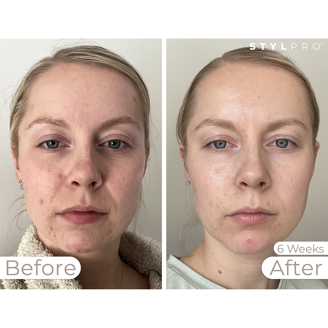 STYLPRO MASK Before & After 4